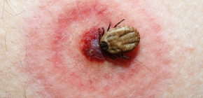 Borreliosa klopi in posledice njihovih ugrizov