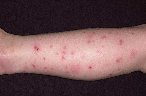 Flich Bites lahko povzročijo alergijske reakcije in dermatitis